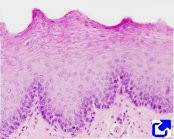 epitelio estratificado plano